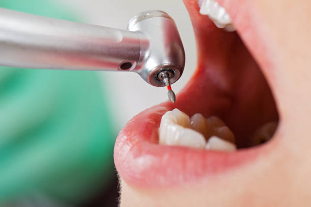 Teeth Whitening in KS
